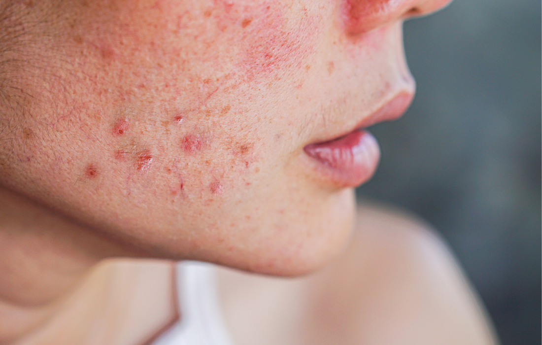 Blog Image, face with acne