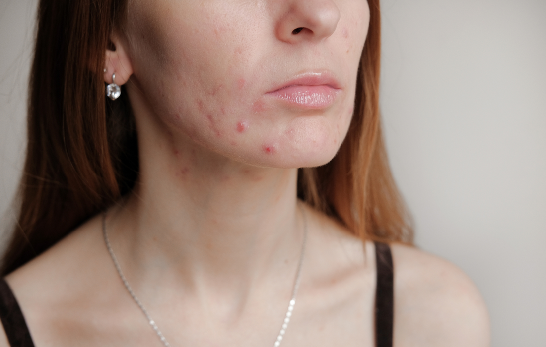 Acne Awareness Month