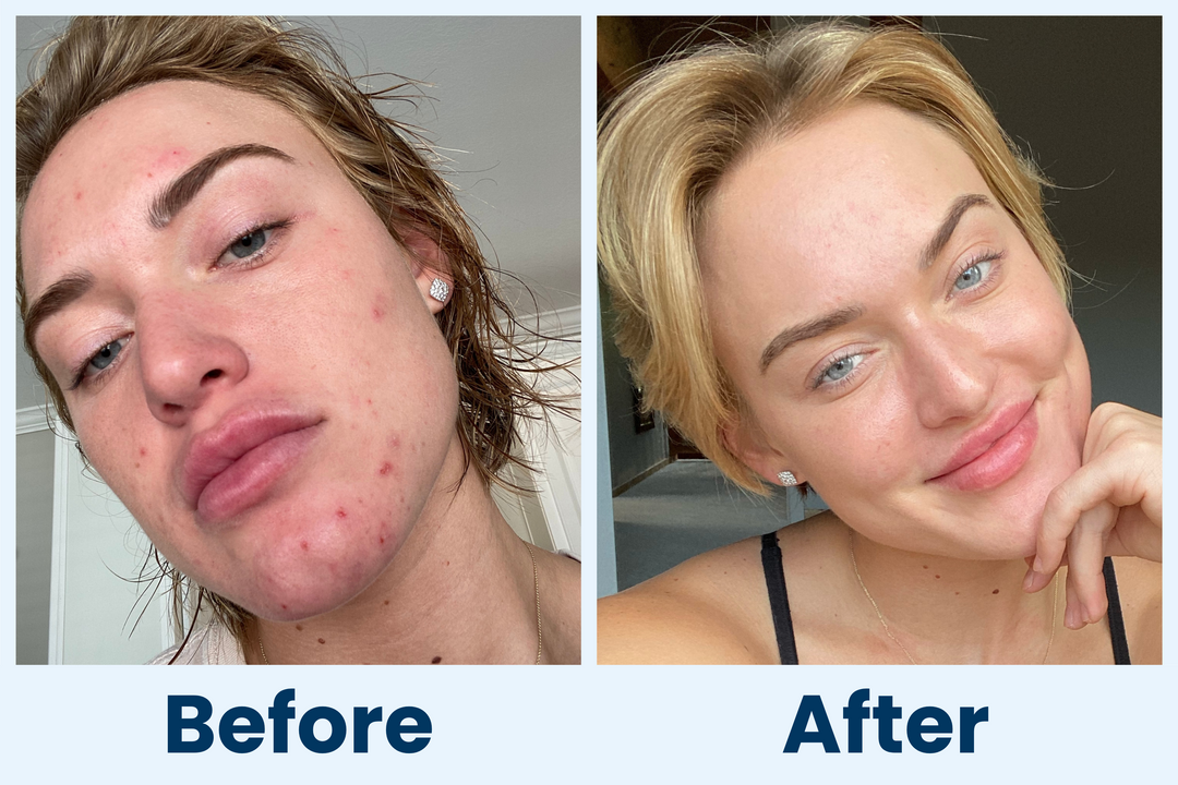 Clean Skin Club