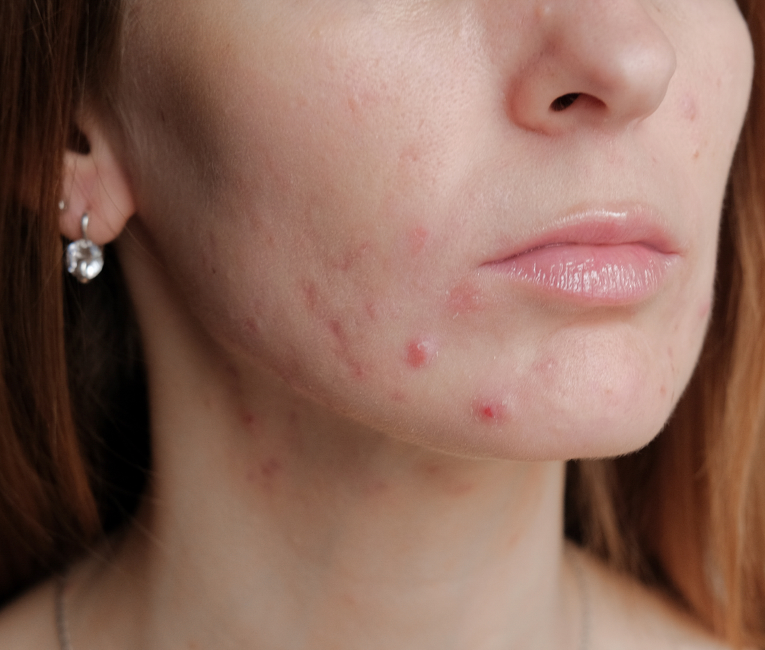 Three Common Types Of Acne