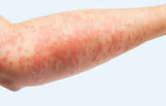 What Is Eczema & How to Manage/Heal it