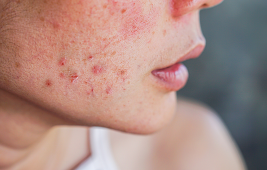 How to Heal Acne Marks