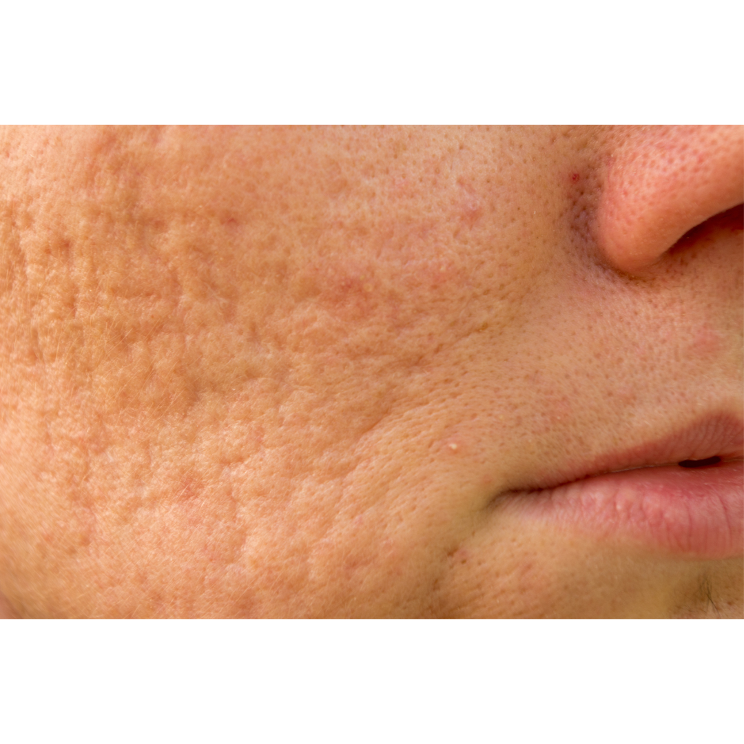 The Different Types of Acne Scarring and How to Correct It