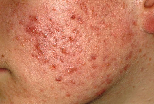 10 Things I Learned in my 10+ Years of Fighting Acne - From a Registered Holistic Nutritionist and Acne Coach