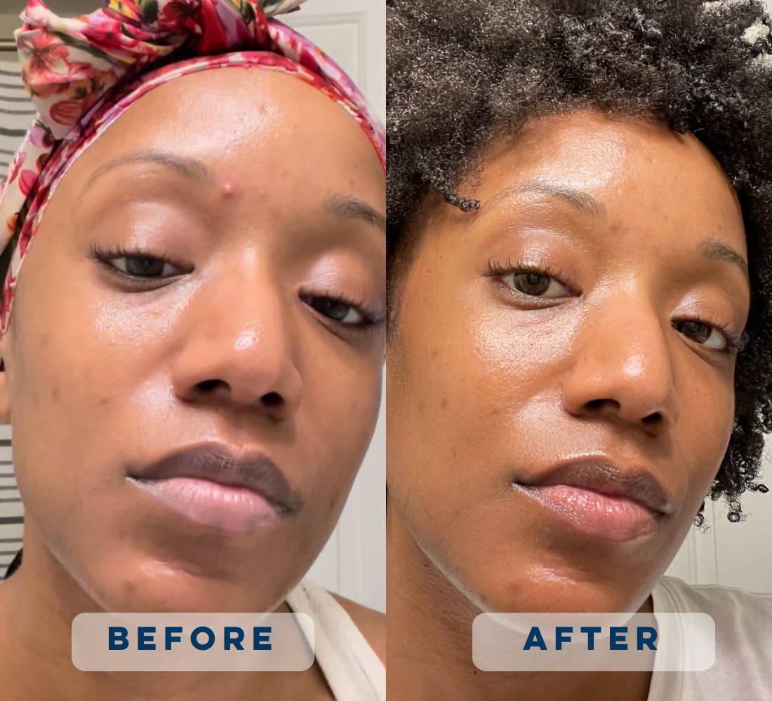 Invisible Patch DermaDot Invisible Pimple Patches – Clean Skin Club