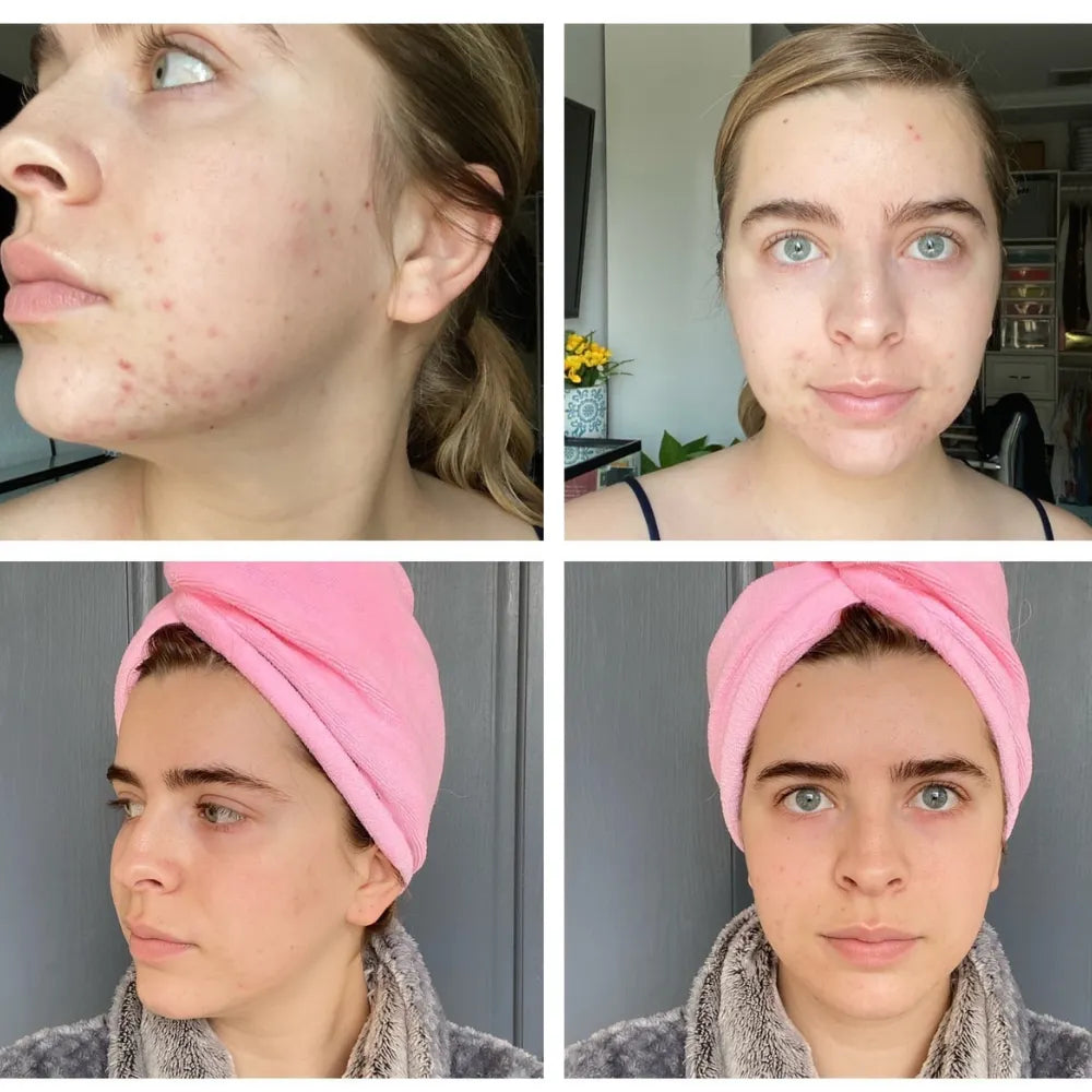 Two before-and-after photos showing skin improvement with reduced acne.