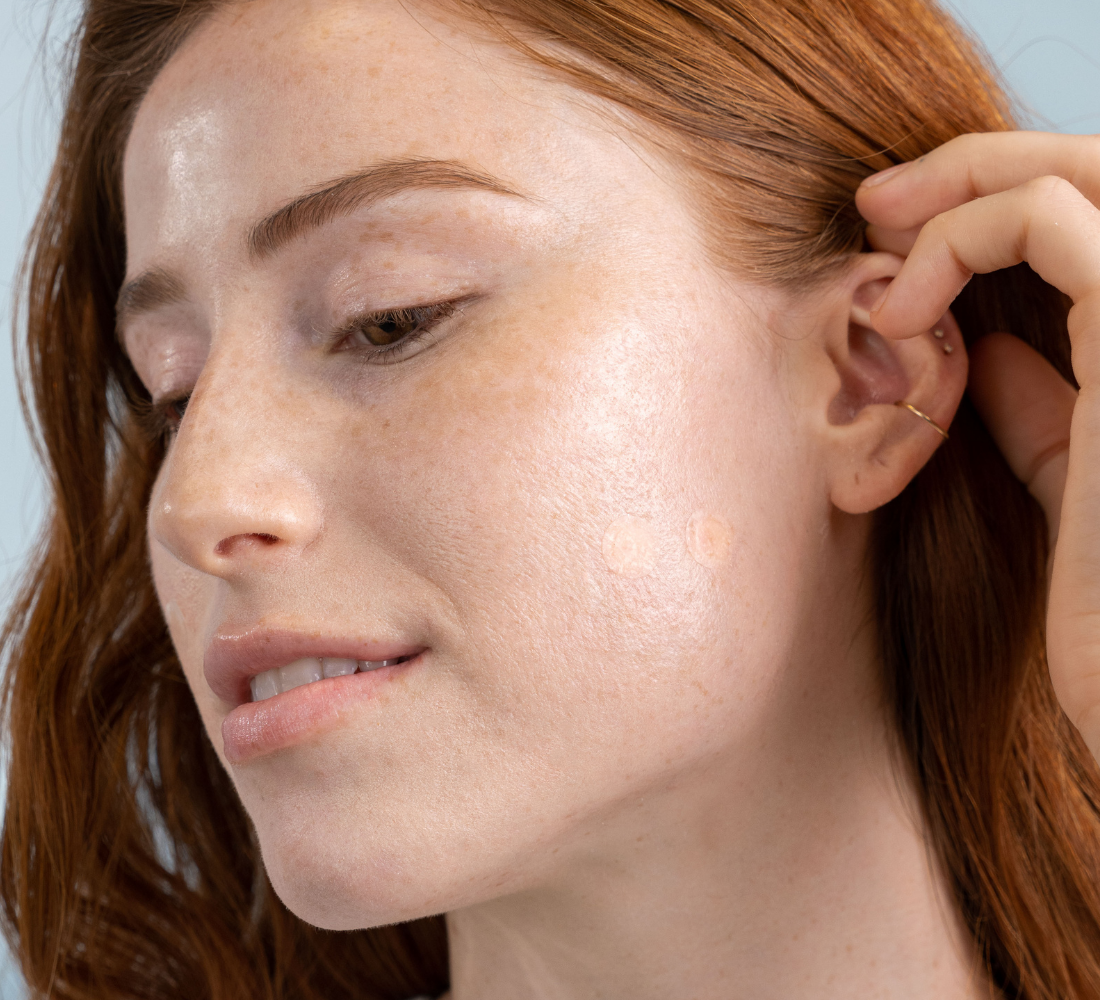 DermaDot Invisible Acne Patches 50 OFF